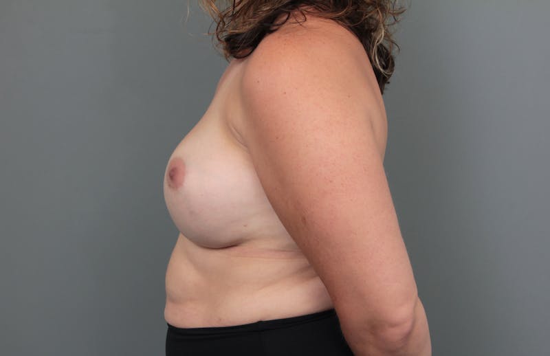 Breast Revision Before & After Gallery - Patient 362987 - Image 5 - Scott Chapin, MD