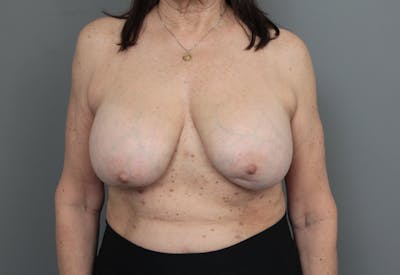 Breast Implant Removal Before & After Gallery - Patient 158110 - Image 1 - Scott Chapin, MD
