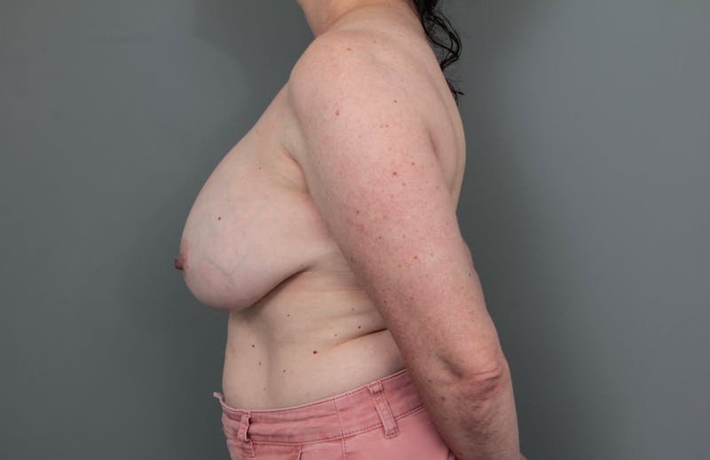 Breast Implant Removal Before & After Gallery - Patient 395447 - Image 3 - Scott Chapin, MD