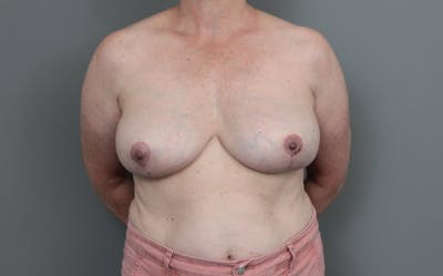 Breast Implant Removal Before & After Gallery - Patient 395447 - Image 2 - Scott Chapin, MD