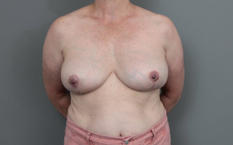 Breast Implant Removal Before & After Gallery - Patient 395447 - Image 2 - Scott Chapin, MD