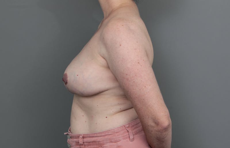 Breast Implant Removal Before & After Gallery - Patient 395447 - Image 4 - Scott Chapin, MD