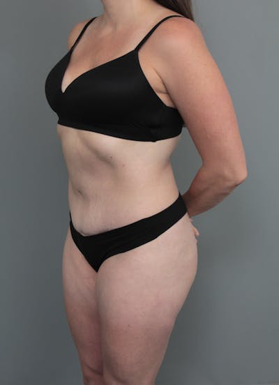 Tummy Tuck Before & After Gallery - Patient 319476 - Image 2 - Scott Chapin, MD