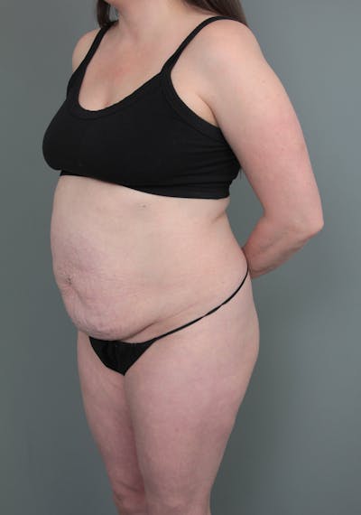 Tummy Tuck Before & After Gallery - Patient 319476 - Image 1 - Scott Chapin, MD