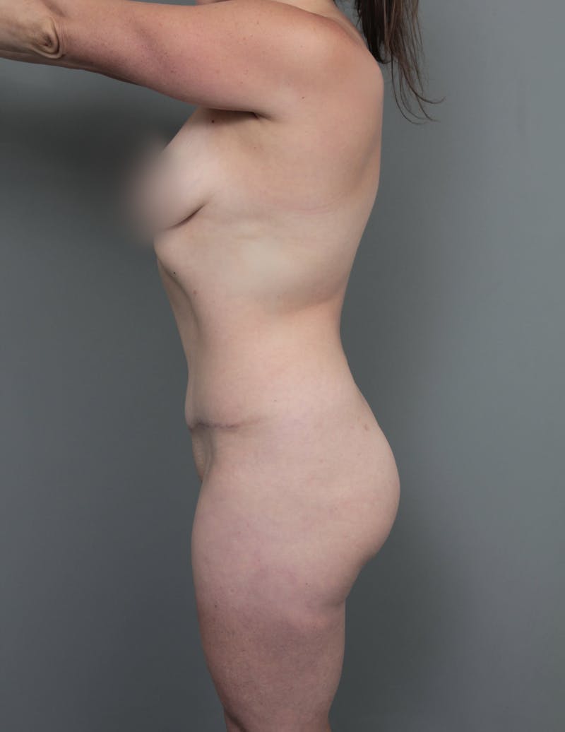 Liposuction Before & After Gallery - Patient 150179 - Image 6 - Scott Chapin, MD