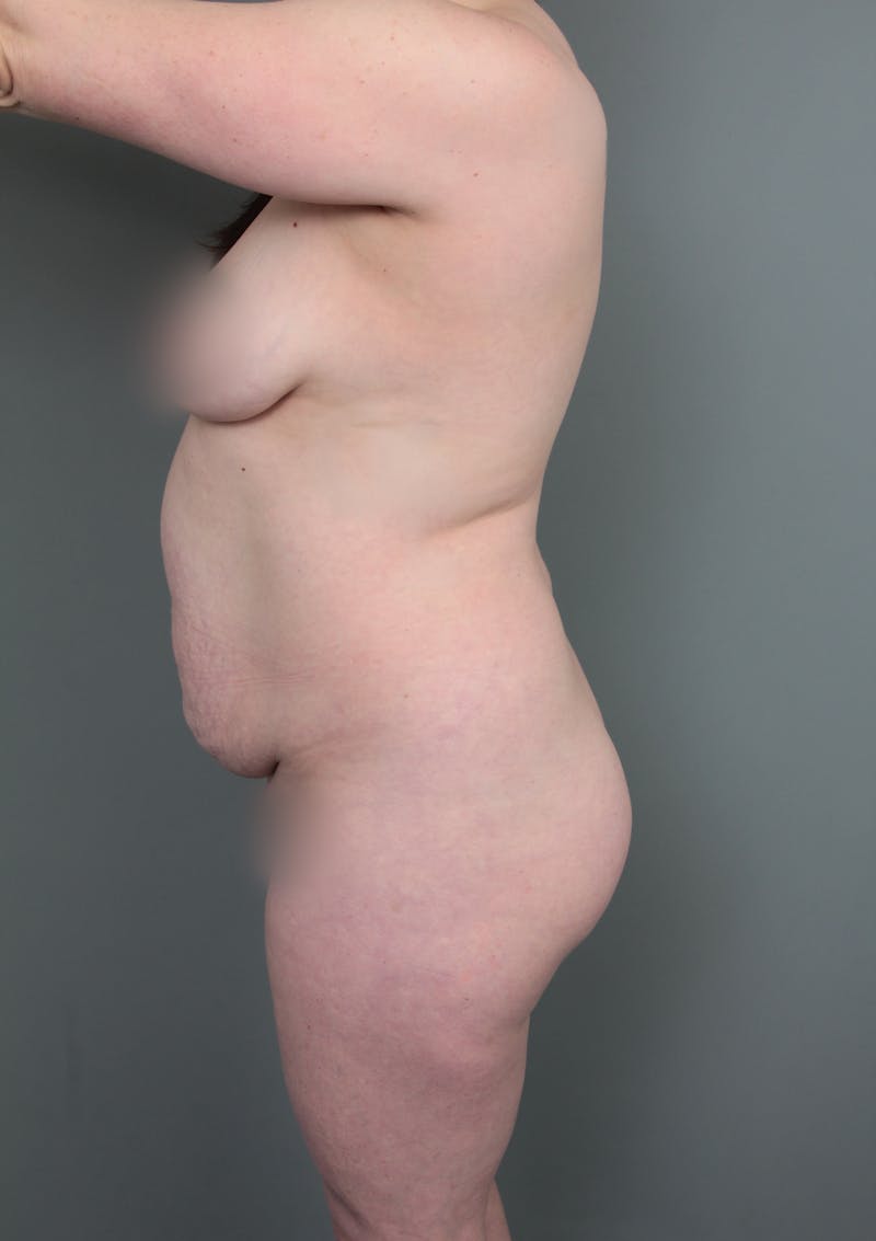 Liposuction Before & After Gallery - Patient 150179 - Image 5 - Scott Chapin, MD