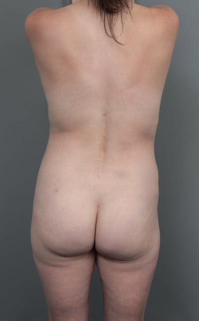 Liposuction Before & After Gallery - Patient 150179 - Image 2 - Scott Chapin, MD