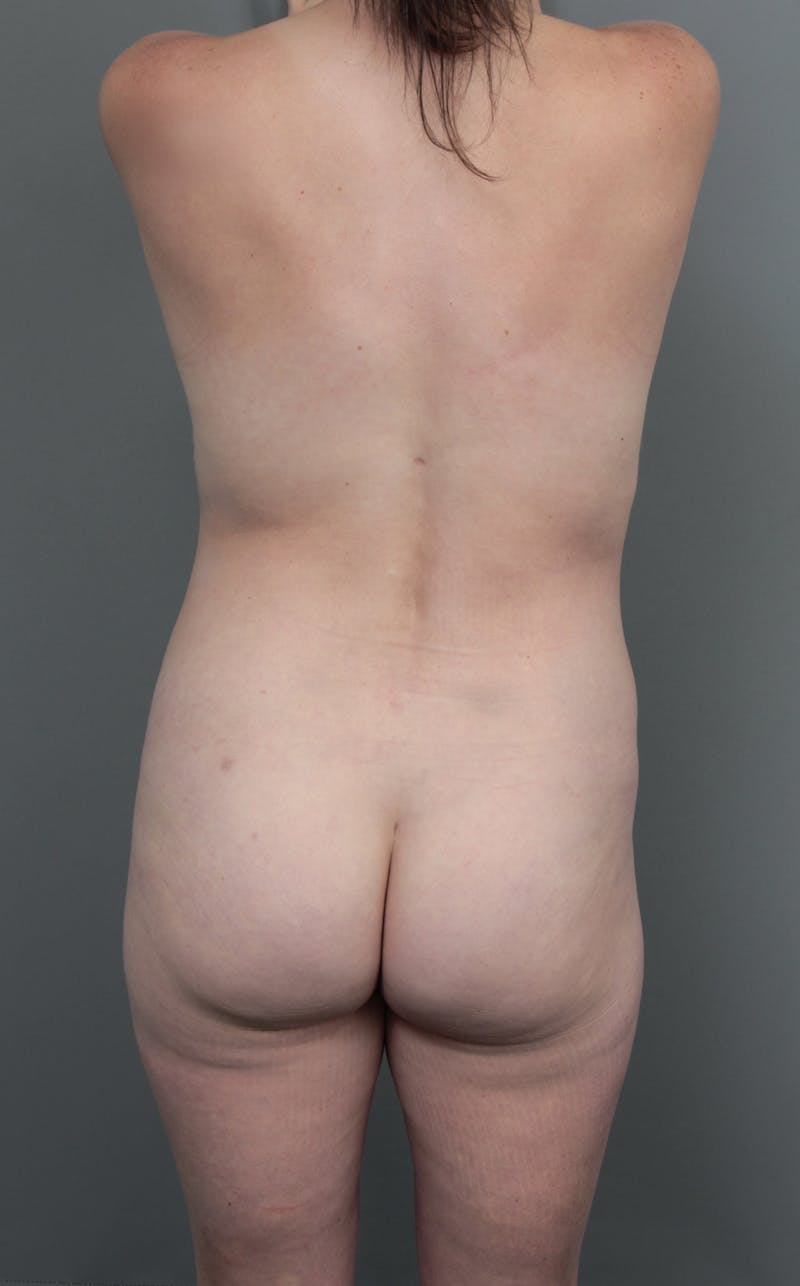 Liposuction Before & After Gallery - Patient 150179 - Image 2 - Scott Chapin, MD