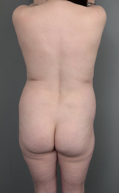 Liposuction Before & After Gallery - Patient 150179 - Image 1 - Scott Chapin, MD