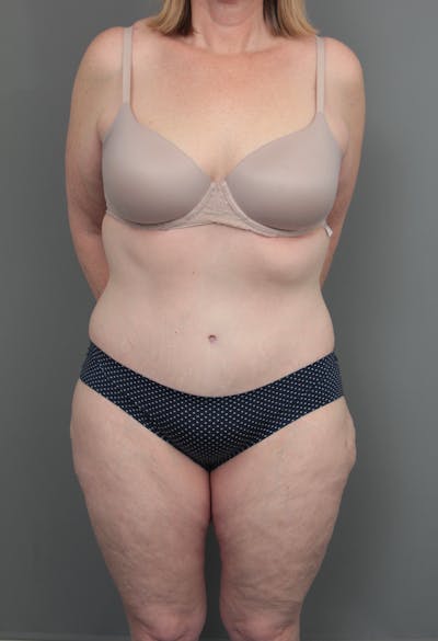Lower Body Lift Before & After Gallery - Patient 393825 - Image 2 - Scott Chapin, MD