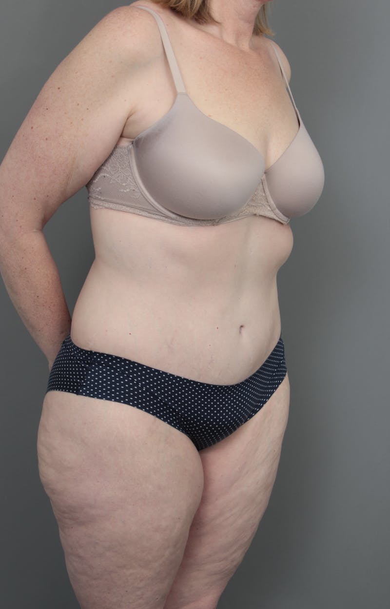 Lower Body Lift Before & After Gallery - Patient 393825 - Image 4 - Scott Chapin, MD