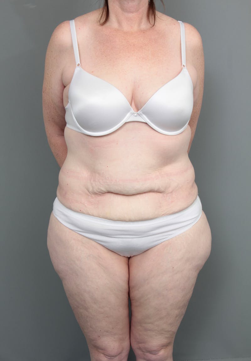 Lower Body Lift Before & After Gallery - Patient 393825 - Image 1 - Scott Chapin, MD