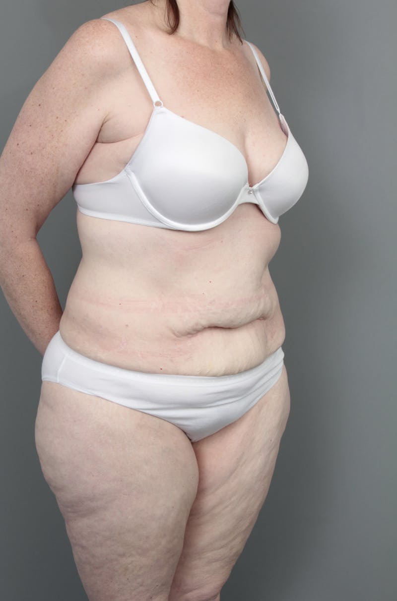 Lower Body Lift Before & After Gallery - Patient 393825 - Image 3 - Scott Chapin, MD