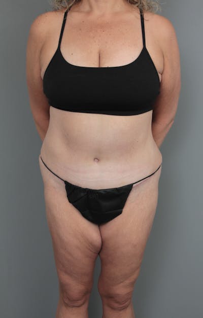 Tummy Tuck Before & After Gallery - Patient 634235 - Image 2 - Scott Chapin, MD