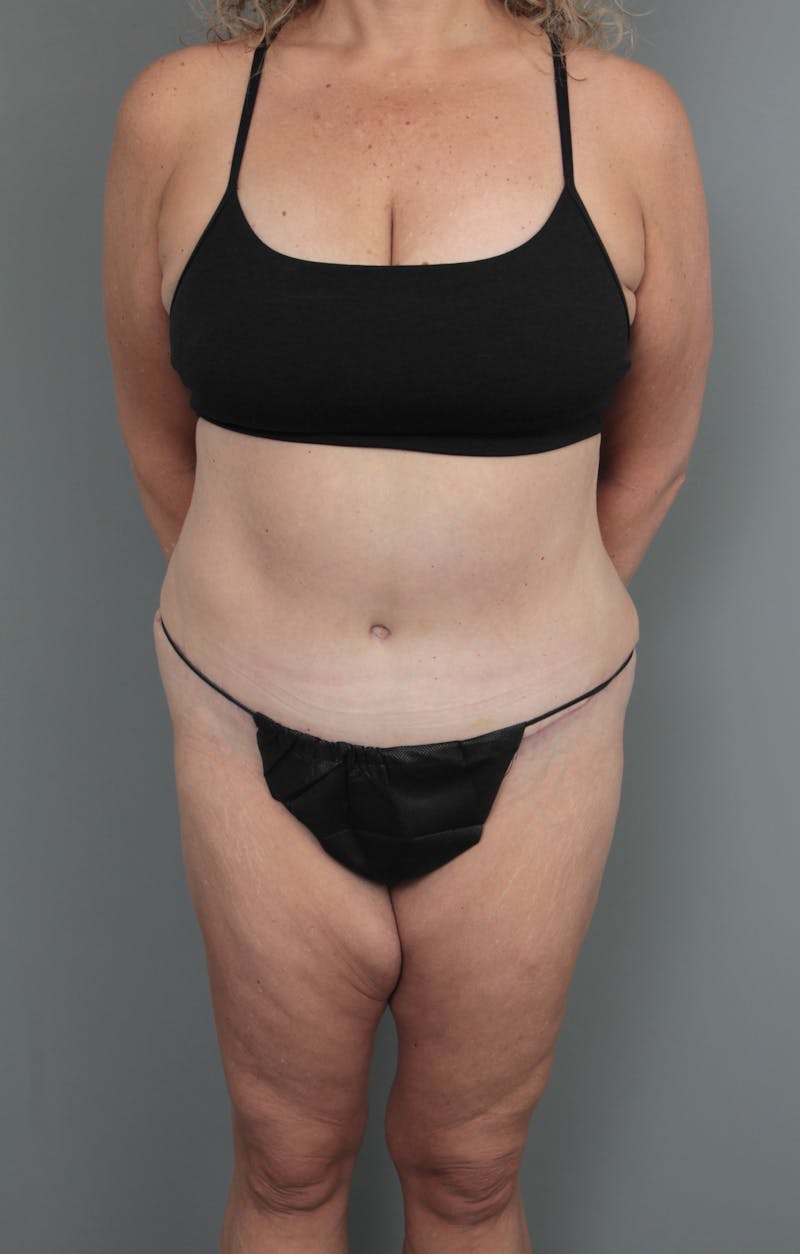 Tummy Tuck Before & After Gallery - Patient 634235 - Image 2 - Scott Chapin, MD