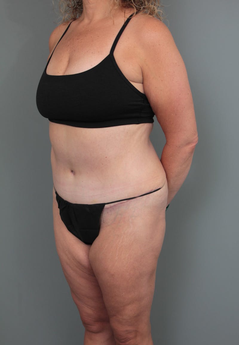 Tummy Tuck Before & After Gallery - Patient 634235 - Image 4 - Scott Chapin, MD