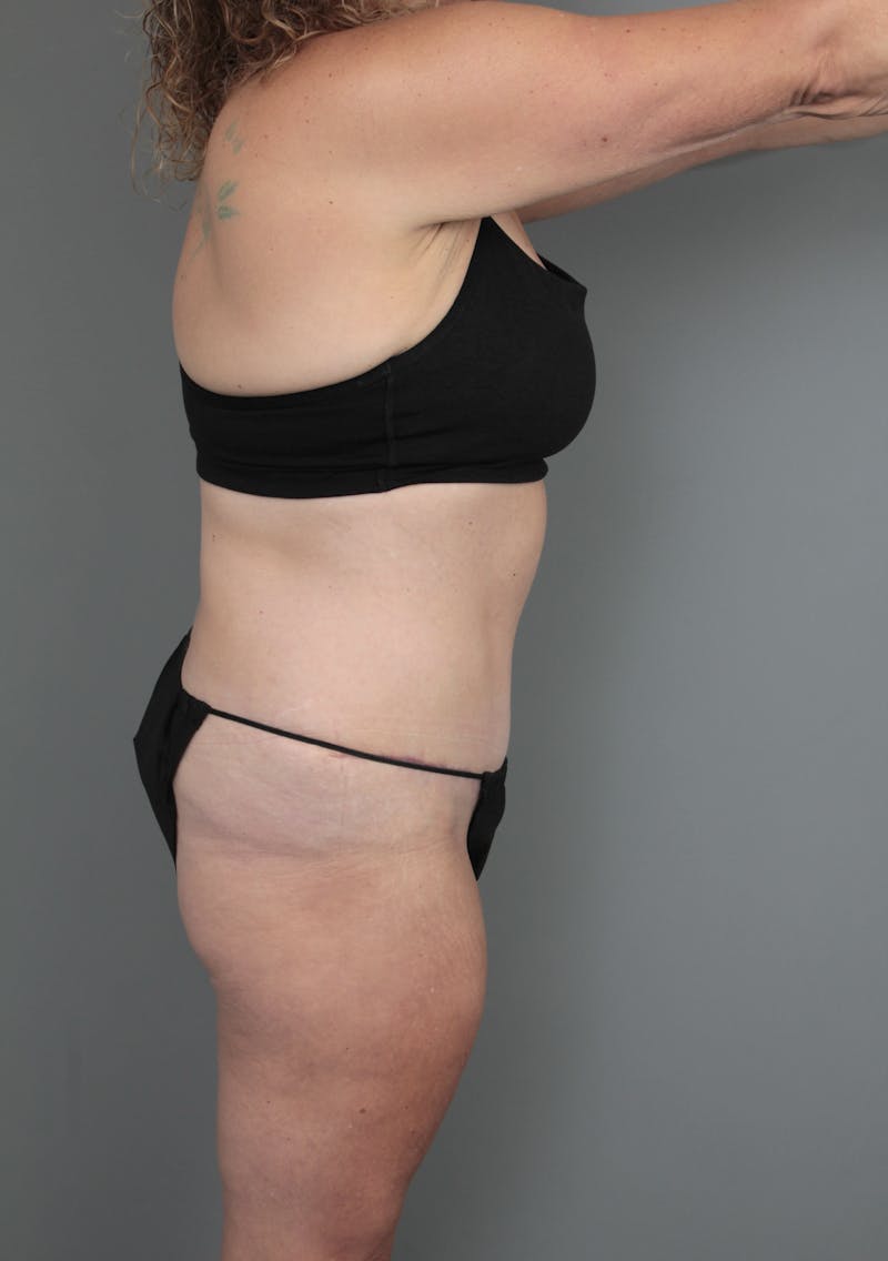 Tummy Tuck Before & After Gallery - Patient 634235 - Image 6 - Scott Chapin, MD