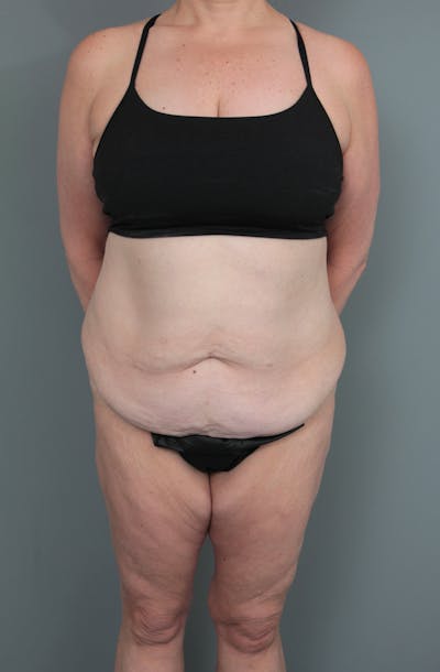 Tummy Tuck Before & After Gallery - Patient 634235 - Image 1 - Scott Chapin, MD