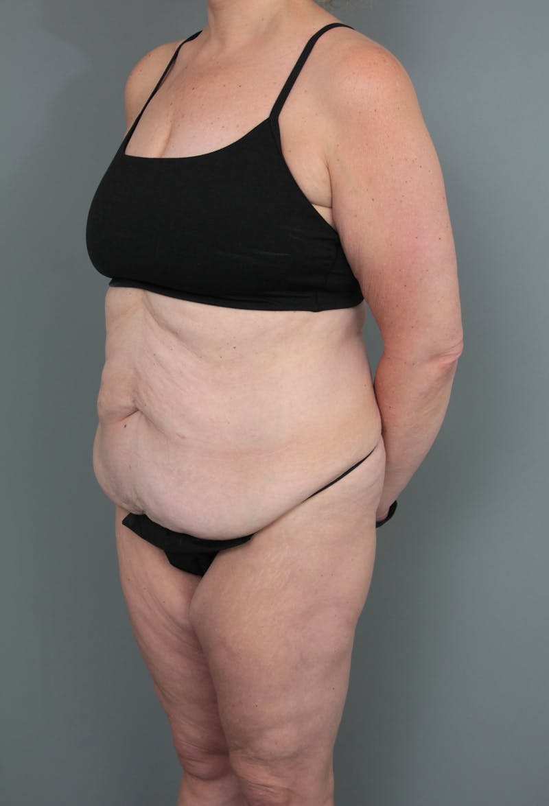 Tummy Tuck Before & After Gallery - Patient 634235 - Image 3 - Scott Chapin, MD