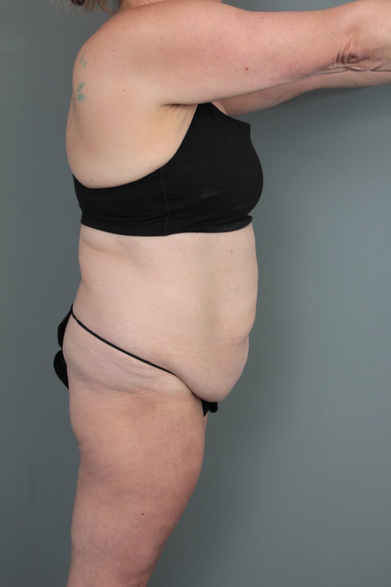 Tummy Tuck Before & After Gallery - Patient 634235 - Image 5 - Scott Chapin, MD