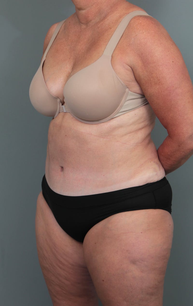 Tummy Tuck Before & After Gallery - Patient 811191 - Image 4 - Scott Chapin, MD