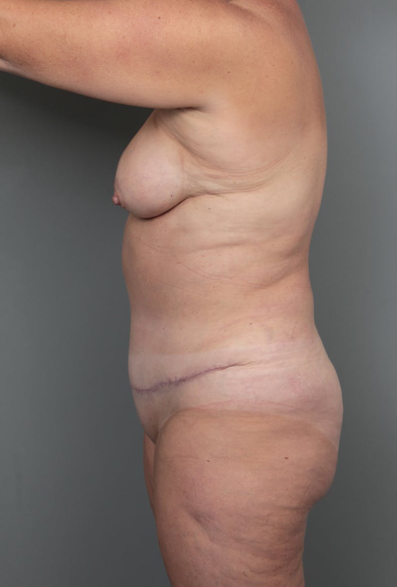 Tummy Tuck Before & After Gallery - Patient 811191 - Image 6 - Scott Chapin, MD