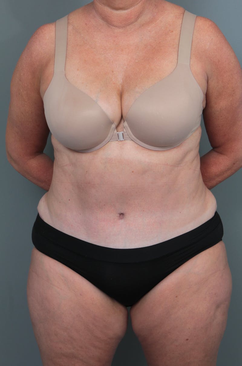 Tummy Tuck Before & After Gallery - Patient 811191 - Image 2 - Scott Chapin, MD