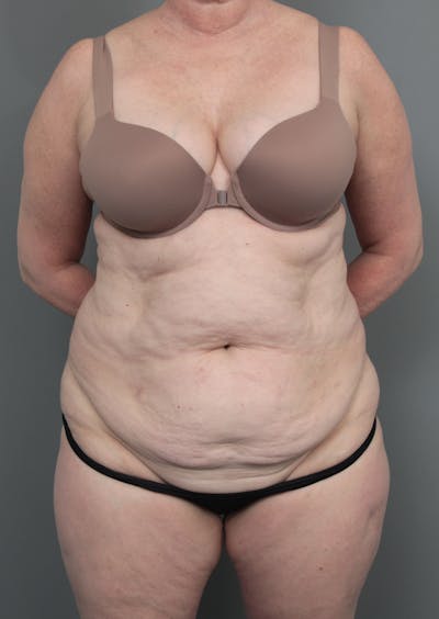 Tummy Tuck Before & After Gallery - Patient 811191 - Image 1 - Scott Chapin, MD