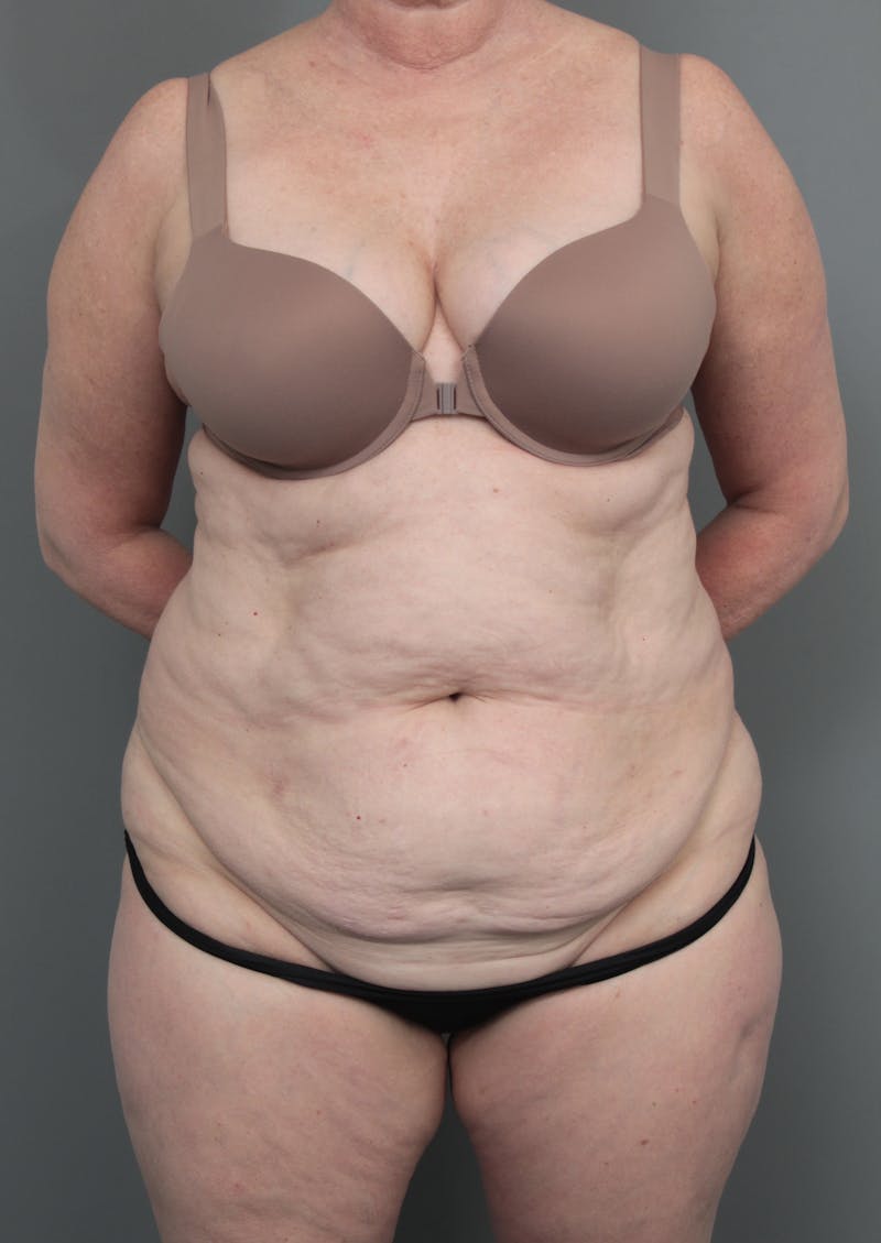 Tummy Tuck Before & After Gallery - Patient 811191 - Image 1 - Scott Chapin, MD