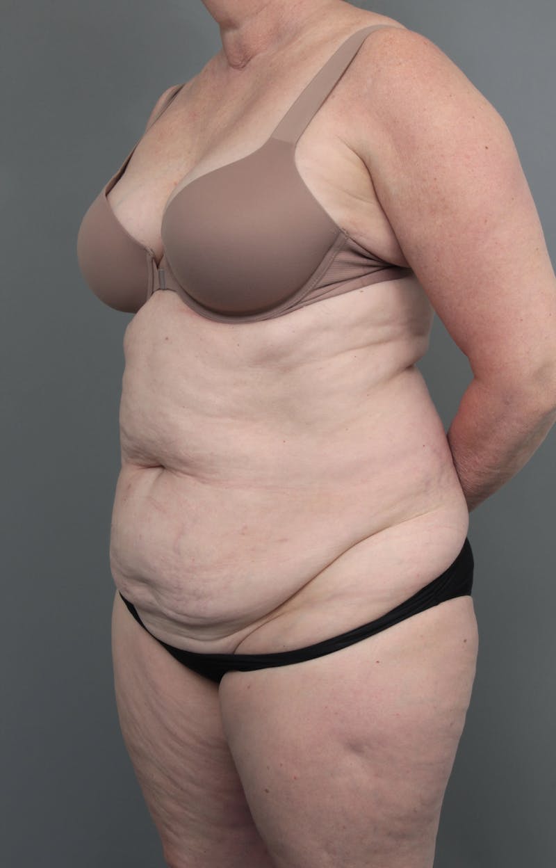 Tummy Tuck Before & After Gallery - Patient 811191 - Image 3 - Scott Chapin, MD