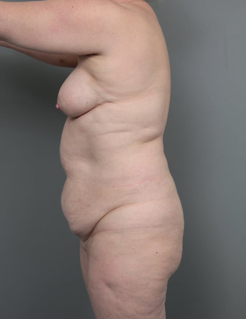 Tummy Tuck Before & After Gallery - Patient 811191 - Image 5 - Scott Chapin, MD