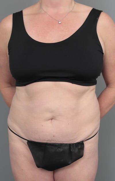 Tummy Tuck Before & After Gallery - Patient 381797 - Image 1 - Scott Chapin, MD
