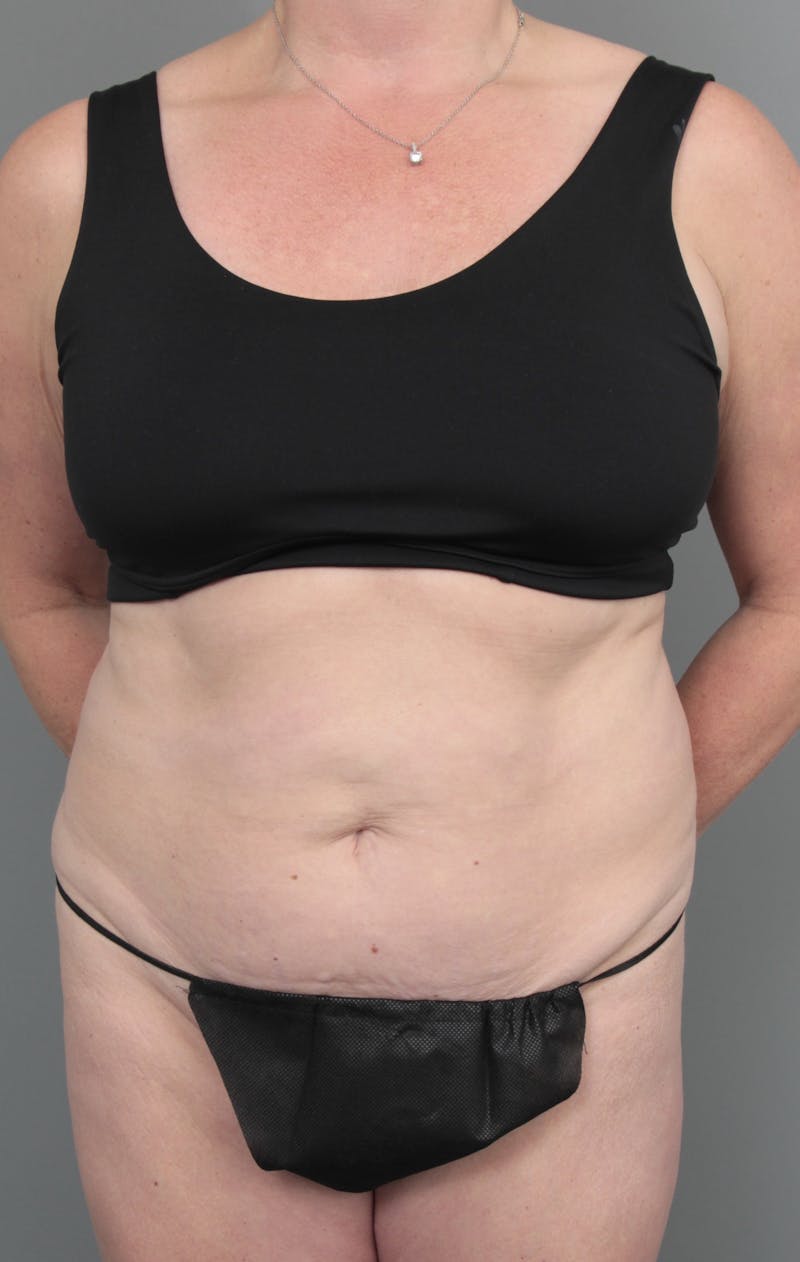 Tummy Tuck Before & After Gallery - Patient 381797 - Image 1 - Scott Chapin, MD