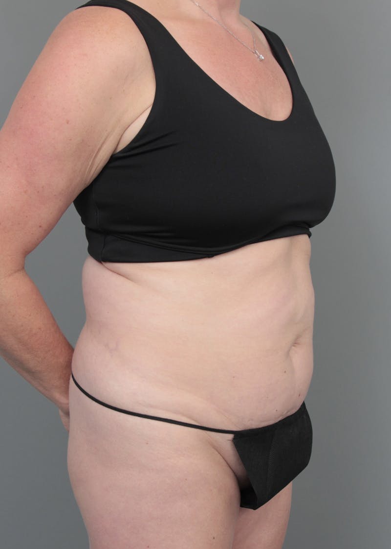 Tummy Tuck Before & After Gallery - Patient 381797 - Image 5 - Scott Chapin, MD