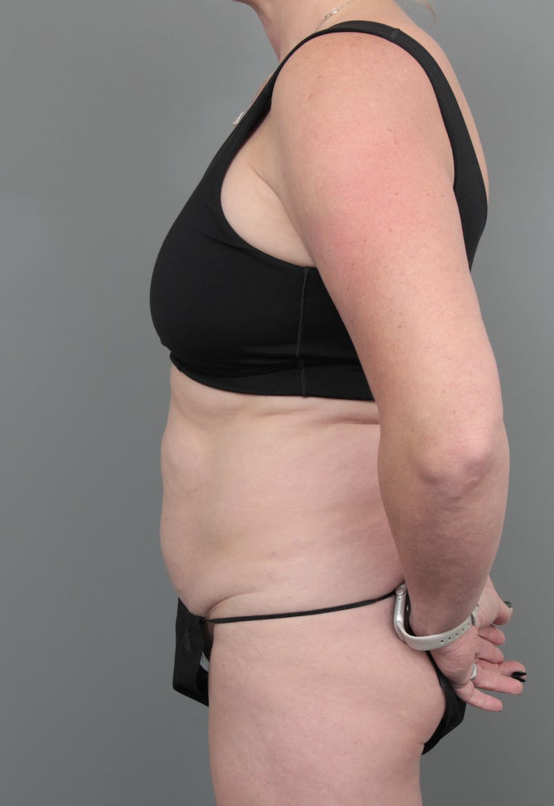 Tummy Tuck Before & After Gallery - Patient 381797 - Image 3 - Scott Chapin, MD
