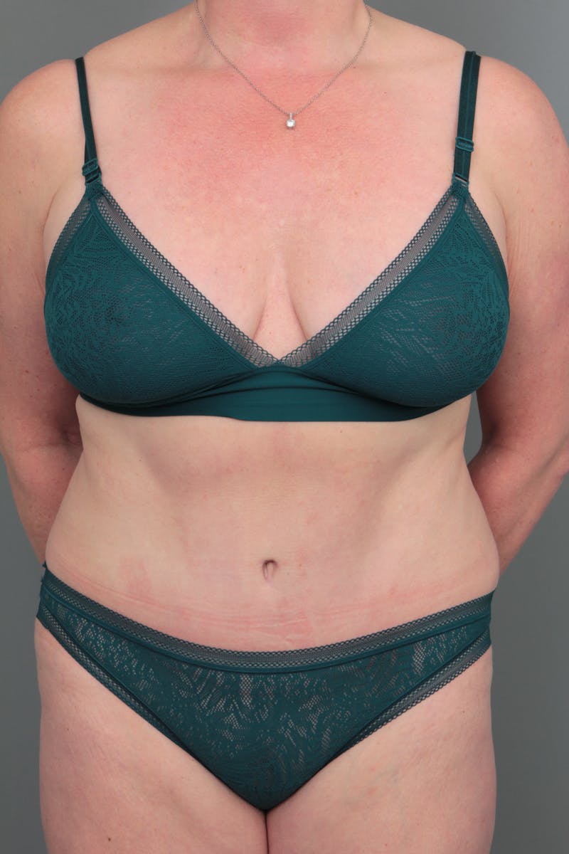 Tummy Tuck Before & After Gallery - Patient 381797 - Image 2 - Scott Chapin, MD