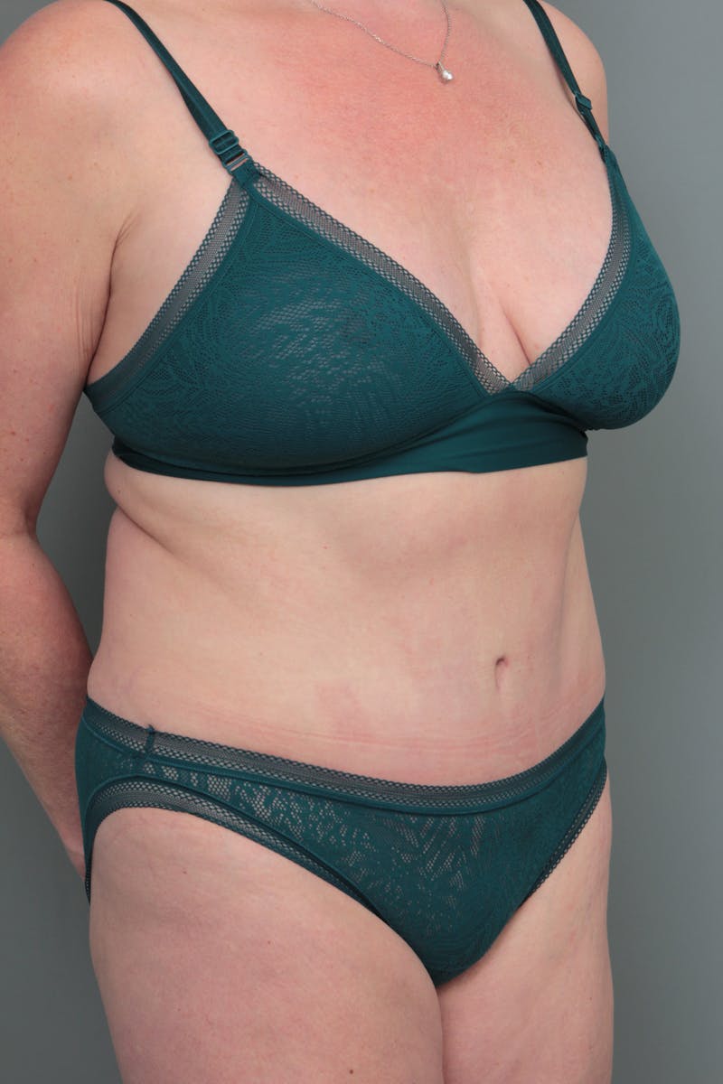 Tummy Tuck Before & After Gallery - Patient 381797 - Image 6 - Scott Chapin, MD