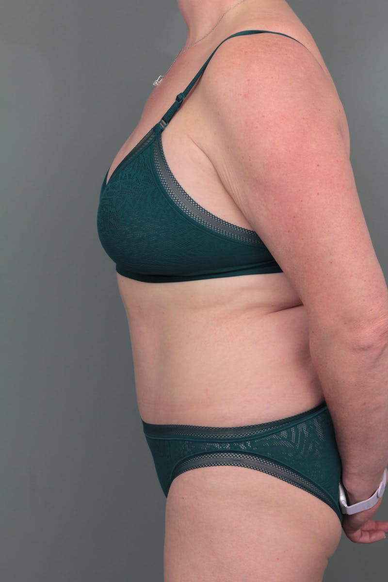 Tummy Tuck Before & After Gallery - Patient 381797 - Image 4 - Scott Chapin, MD
