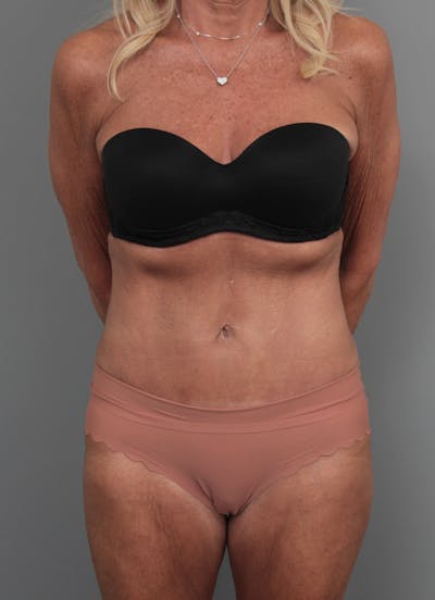Tummy Tuck Before & After Gallery - Patient 551053 - Image 2 - Scott Chapin, MD