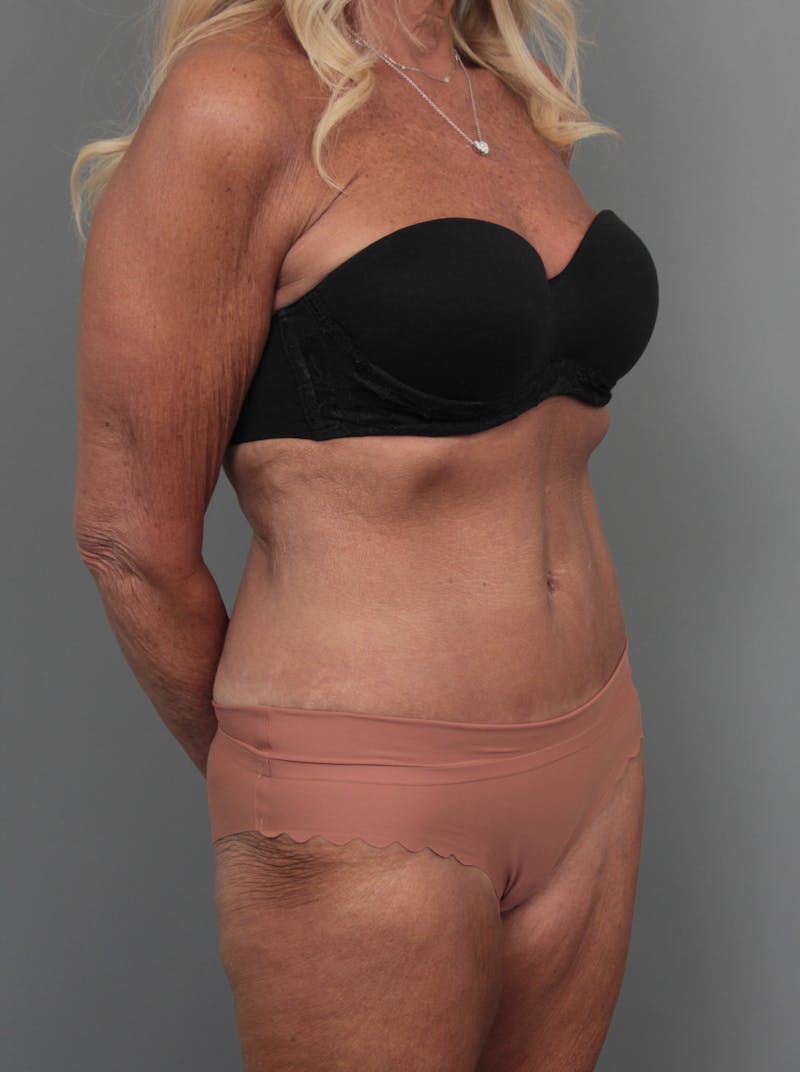 Tummy Tuck Before & After Gallery - Patient 551053 - Image 6 - Scott Chapin, MD