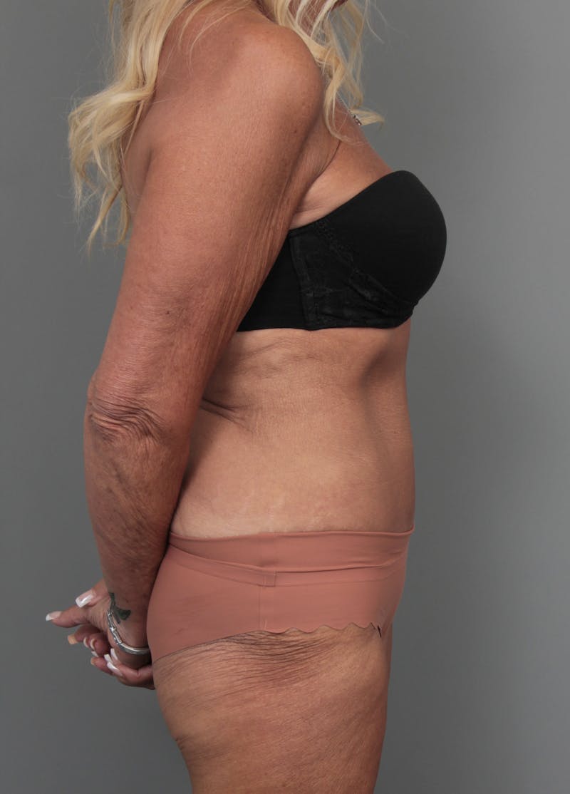 Tummy Tuck Before & After Gallery - Patient 551053 - Image 4 - Scott Chapin, MD