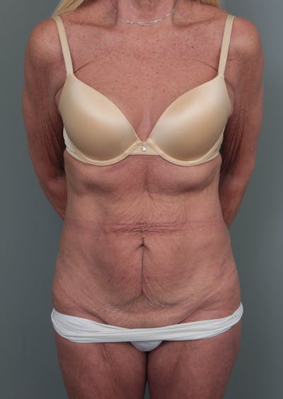 Tummy Tuck Before & After Gallery - Patient 551053 - Image 1 - Scott Chapin, MD