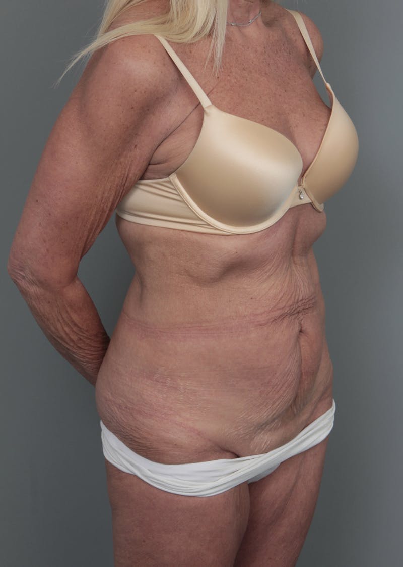 Tummy Tuck Before & After Gallery - Patient 551053 - Image 5 - Scott Chapin, MD