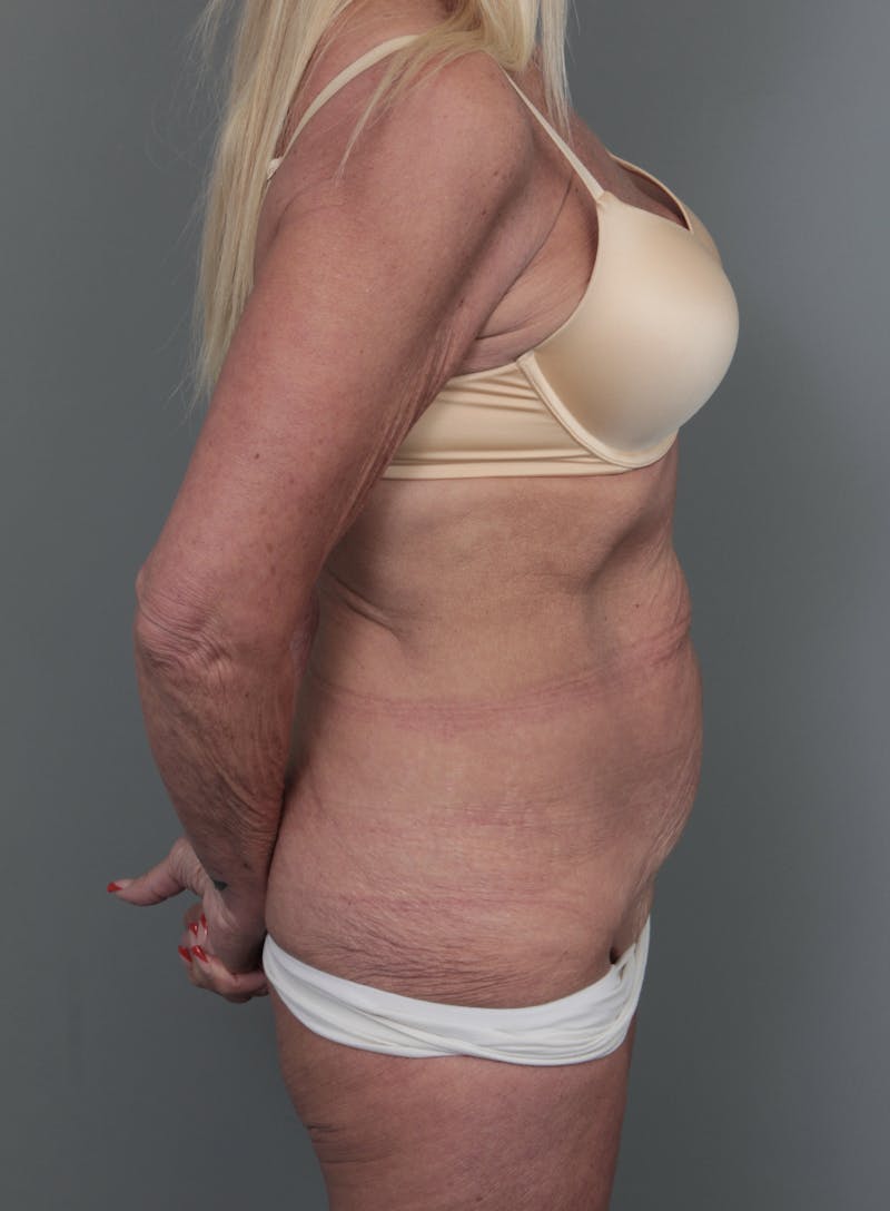 Tummy Tuck Before & After Gallery - Patient 551053 - Image 3 - Scott Chapin, MD