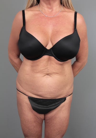 Tummy Tuck Before & After Gallery - Patient 254081 - Image 1 - Scott Chapin, MD