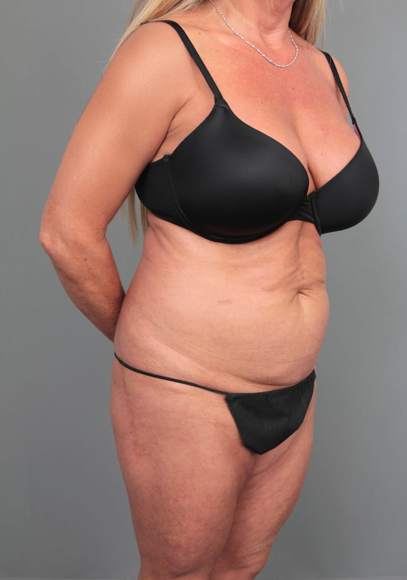 Tummy Tuck Before & After Gallery - Patient 254081 - Image 3 - Scott Chapin, MD