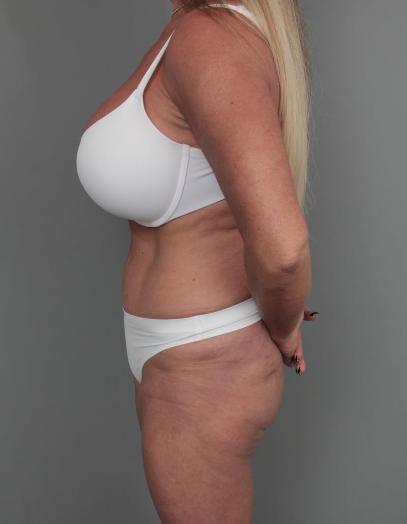Tummy Tuck Before & After Gallery - Patient 254081 - Image 5 - Scott Chapin, MD