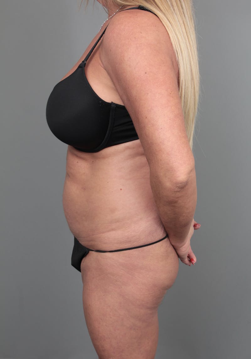 Tummy Tuck Before & After Gallery - Patient 254081 - Image 6 - Scott Chapin, MD