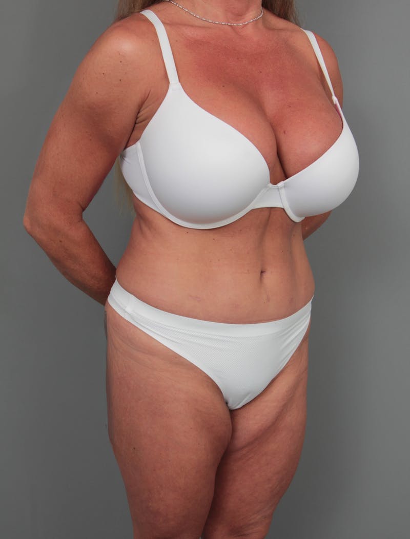 Tummy Tuck Before & After Gallery - Patient 254081 - Image 4 - Scott Chapin, MD