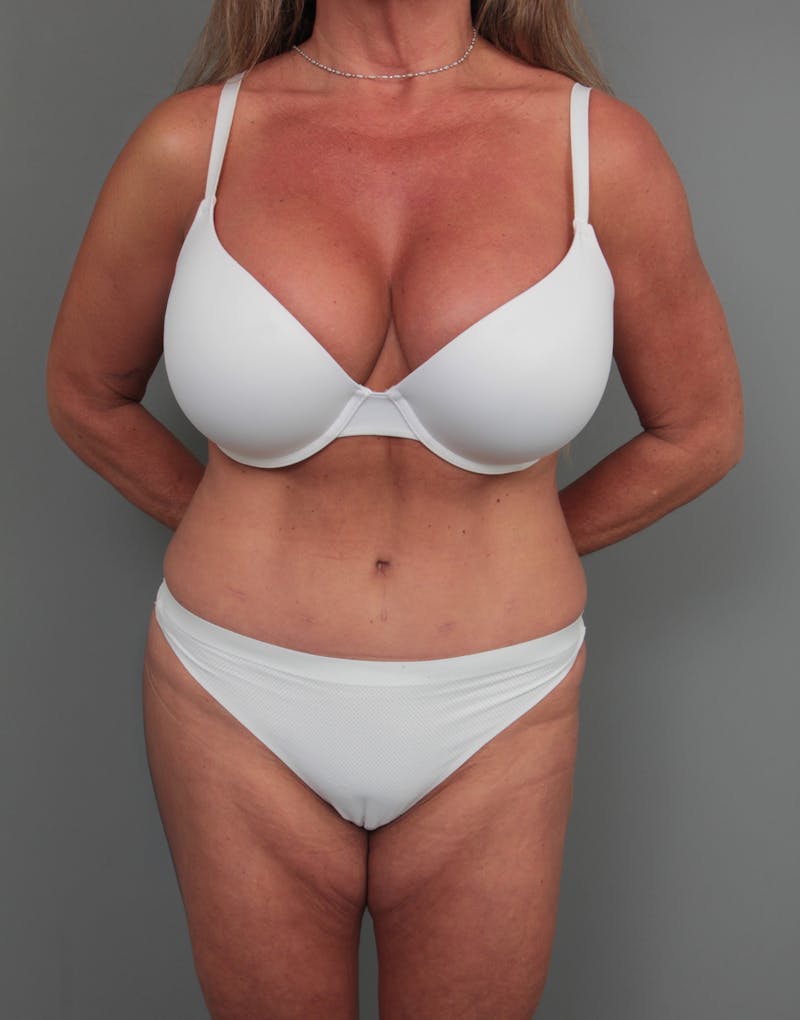 Tummy Tuck Before & After Gallery - Patient 254081 - Image 2 - Scott Chapin, MD